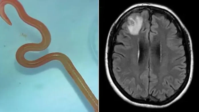 Por primera vez extraen un gusano parásito del cerebro de una mujer